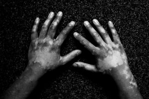 A vitiligo kezelésére vannak lehetőségek
